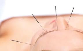 acupuntura_funciona